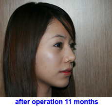 plastic-surgery-chin-augmentation